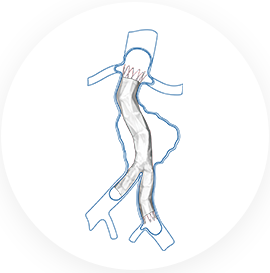 Aegis®/定海石™分叉型大动脉覆膜支架及输送系统