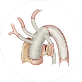 CRONUS®/通天刀™术中支架系统